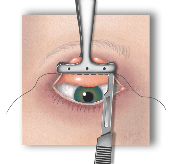 Ptosis-Clamp.jpg