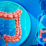 Cáncer de colon La importancia de la prevención