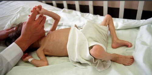 En-medio-de-la-pandemia-mueren-niños-por-desnutrición-en-el-Valle.jpg