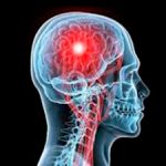 Accidente cerebrovascular: la clave es identificarlo y actuar a tiempo