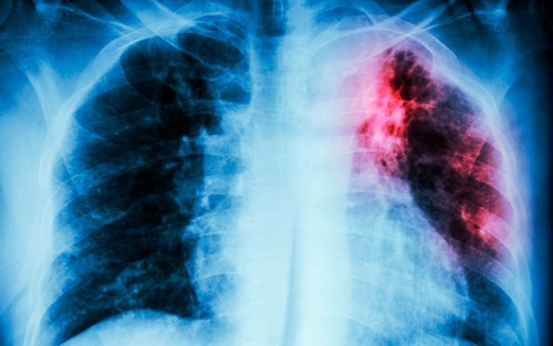 COVID-19-retrasa-atencion-mundial-contra-la-tuberculosis2.jpg