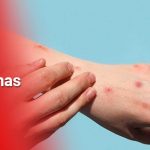 3.413 los casos de viruela del mono en cincuenta países