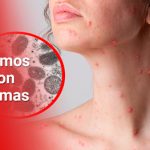 En Cali se definen acciones para prevenir viruela del mono