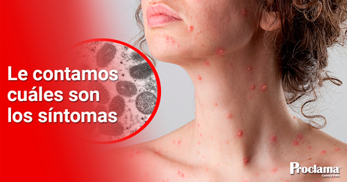 En-Cali-se-definen-acciones-para-prevenir-viruela-del-mono-1.jpg