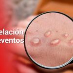 Se confirma primer caso símico en Cali