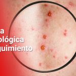 Primer caso de Viruela del Mono en el Valle permanece bajo seguimiento
