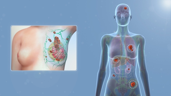 Crean el primer SIG para mejorar la atención de pacientes con cáncer de mama en Colombia